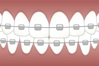 Ortodontia - Aparelhos fixos e móveis