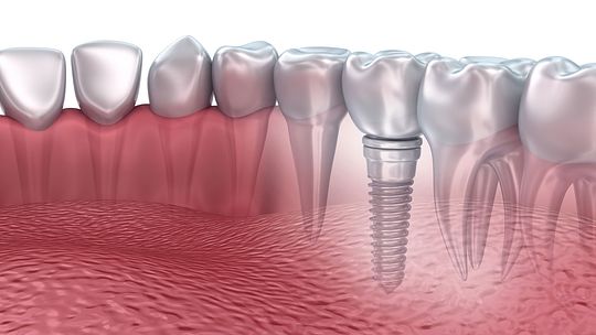 implante-dentario.jpg