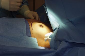 Mamoplastia de aumento