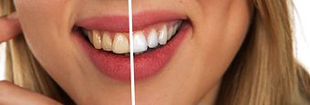 Branqueamento Dentário (Externo e Interno)