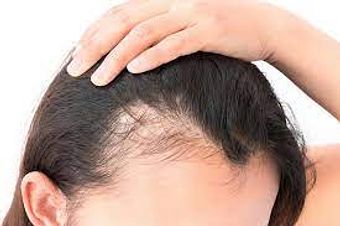 Tratamento para Calvície (Queda de Cabelo, Alopecia)